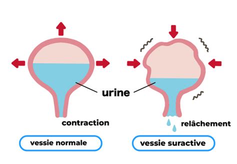 Tout Savoir Sur Les Fuites Urinaires Prévention Traitement Et Causes