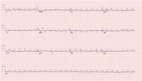 Acute Pulmonary Embolus