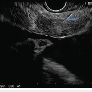 Endoscopic ultrasound image showing needle biopsy of the... | Download ...