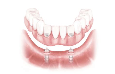 Dental Implants Preserve Bone The Dental Implant Guide