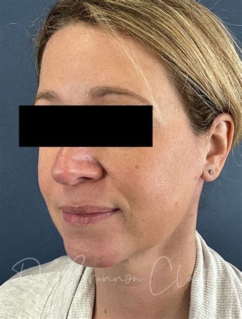 MyEllevate Neck Lift Claytor Noone