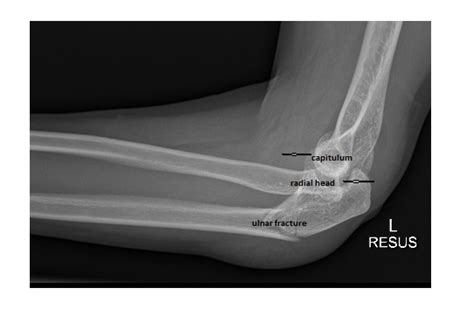 Imaging Case Of The Week 248 Answer Emergucate