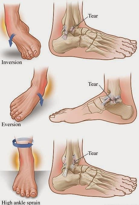 Nhwc Media Blog Rehabilitation Of Ankle Sprains