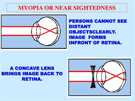 Ppt Defects Of Vision Powerpoint Presentation Free Download Id1772432