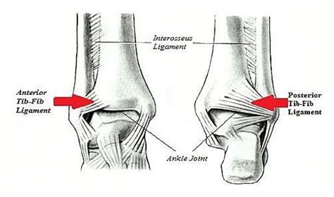 Ankle Sprain In Singapore Things You Need To Know Orthocare Sg