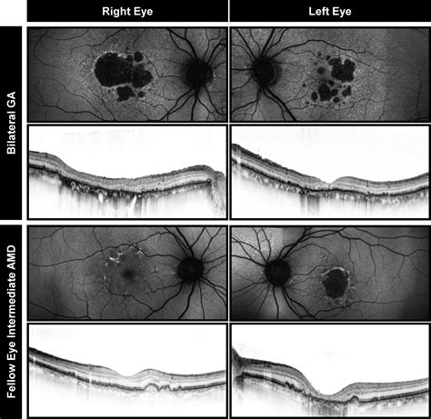 The Progression Of Geographic Atrophy Secondary To Age Related Macular