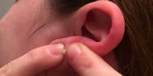 Earlobe Pimples Causes And Remedies For These Zits Skincarederm