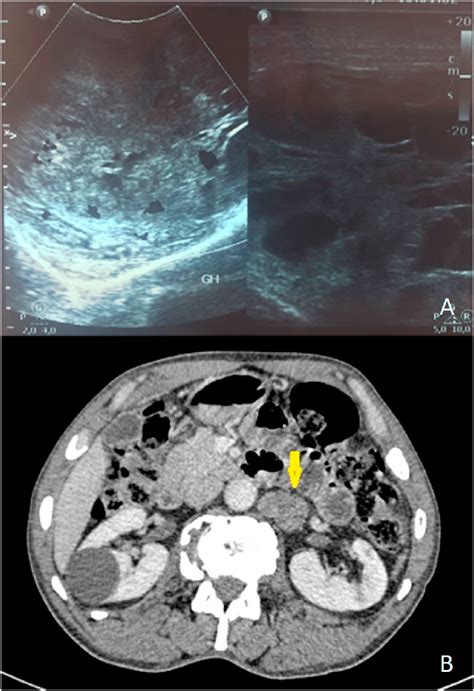 A Scrotal Ultrasound Demonstrating A Large Solid Cystic Mass B The