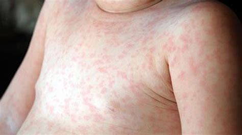 5 Instant Home Remedies For Effective Treatment Of Roseola | TheHealthSite.com