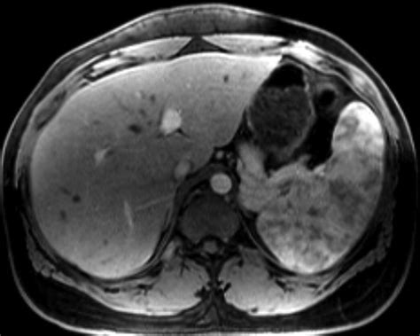 MRI Arterial Enhancement Fraction In Hepatic Fibrosis And Cirrhosis AJR