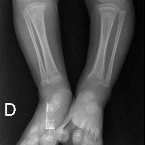 Pdf Congenital Syphilis With Bone Lesion Case Report