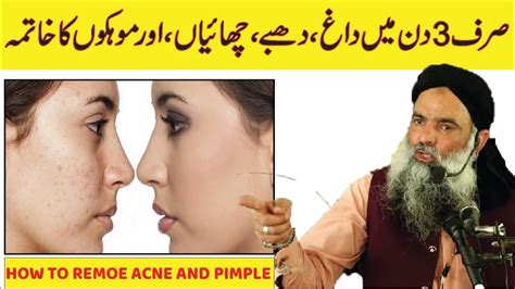 Chehre Ke Daagh Dhabon Ka Ilaj How To Remoe Acne And Pimple Moka Khatam