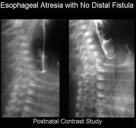 Tracheoesophageal Fistula X Ray