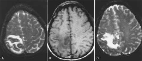 Infectious And Noninfectious Inflammatory Diseases Of The Brain