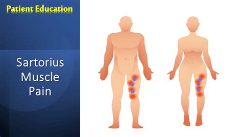 Sartorius Muscle Pain