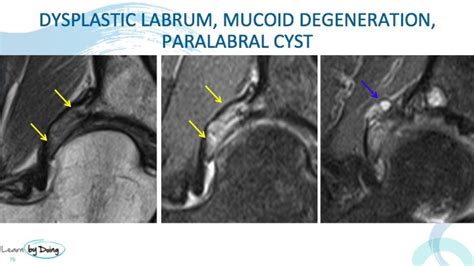 Dysplastic Labrum Acetabular Labrum More Than Just Tears Part