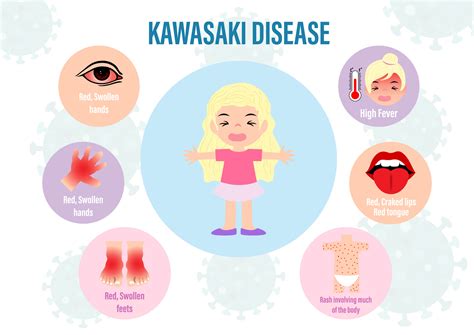 Kawasaki Disease What Is Symptoms Diagnosis And Treatment