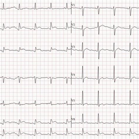 Electrocardiography On Admission Showed Sinus Rhythm With Mm St