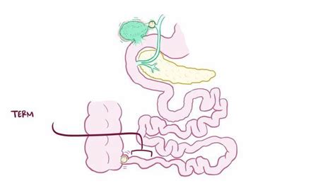 Gallstone ileus - Alchetron, The Free Social Encyclopedia