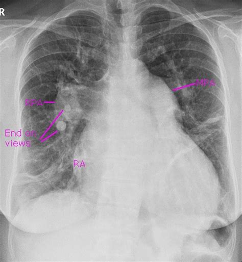 Severe Pulmonary Hypertension On Cxr All About Cardiovascular System