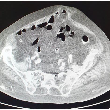 Preoperative Abdominal Computed Tomography Scan Showing The Protrusion