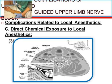 Ultrasound guided upper limb nerve block | PPT