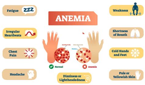 What's Anemia? Causes, Symptoms & Treatments - SunExport