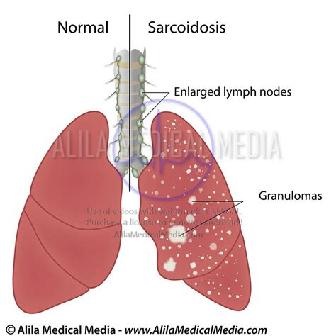 Alila Medical Media Pulmonary Sarcoidosis Medical Illustration