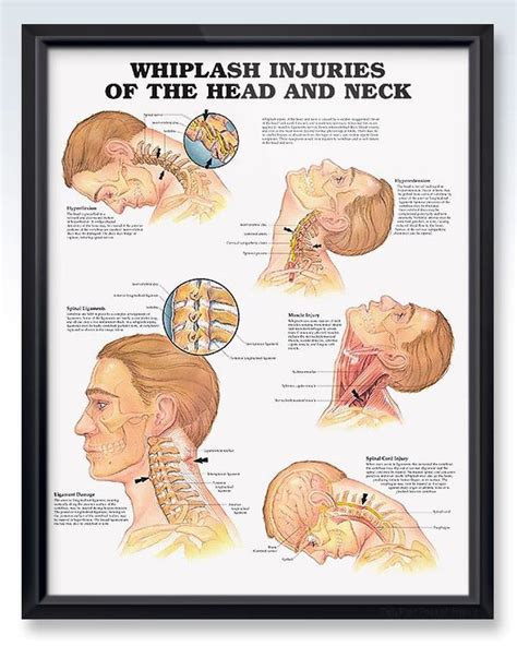 Whiplash Injuries of the Head and Neck Chart 20x26 | Whiplash injury ...