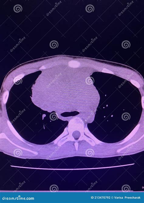 CT Scan Mass at Interior Mediastinum Stock Photo - Image of hereditary, medicine: 213470792