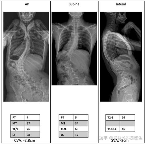 成人特发性脊柱侧弯的新分型 知乎