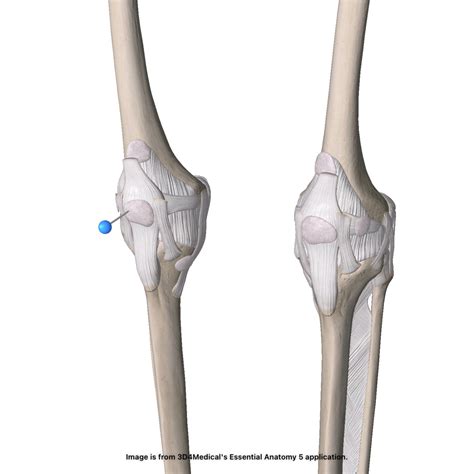 Joint Dislocation