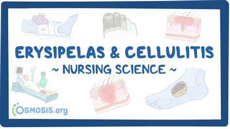 Erysipelas and cellulitis: Nursing: Video & Causes | Osmosis