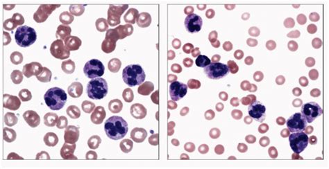 Chronic Neutrophilic Leukemia Basicmedical Key