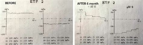 Inflation-deflation test result before and after tympanoplasty with... | Download Scientific Diagram