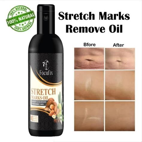 Focufix Present Repair Stretch Marks Removal Natural Heal Pregnancy