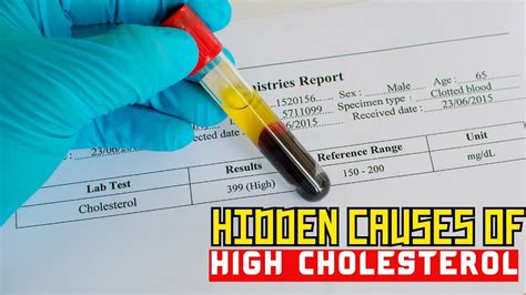 The Hidden Causes Of High Cholesterol Revealed Lower Your