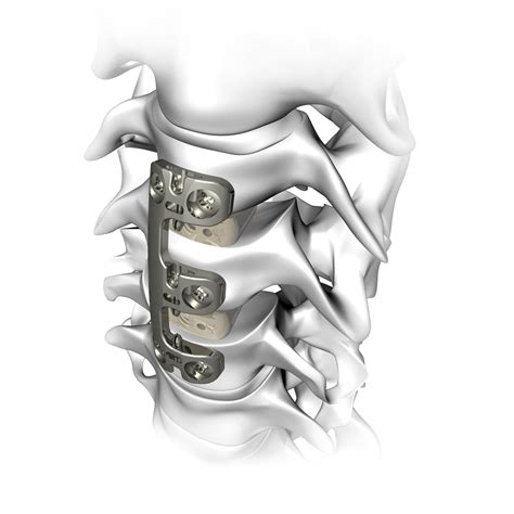 HWS Arthrodeseplatte VERTEVIEW Atlas Spine Mit Verriegelung