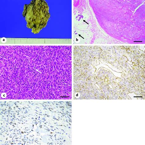 Histological Findings Of Case A The Gross Resected Specimen Is A