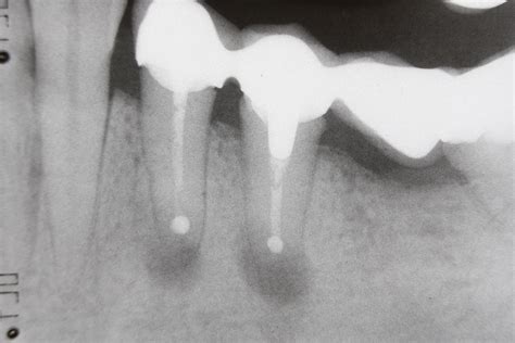 File:Dental X-ray 75.JPG - Wikimedia Commons