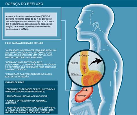 Obesidade E Cirurgia Refluxo