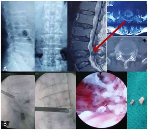 Percutaneous Endoscopic Lumbar Discectomy Via Transforaminal Approach Hot Sex Picture