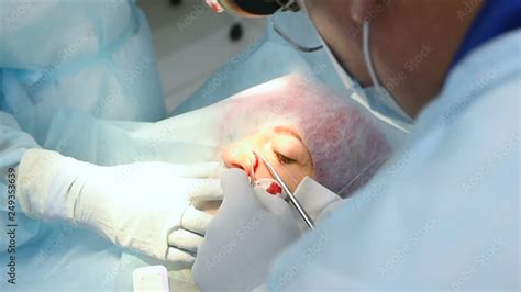 The Surgeon Dermatologist Sutures The Wound After Surgical Removal Of A Mole Or Nevus On The