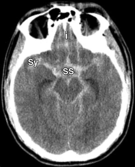 Subarachnoid Hemorrhage Beyond Aneurysms Ajr