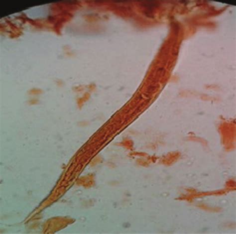 Ancylostoma Duodenale Morphology Labeled