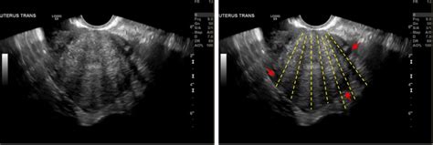 I Saw The Venetian Blind Sign Clinical Imaging