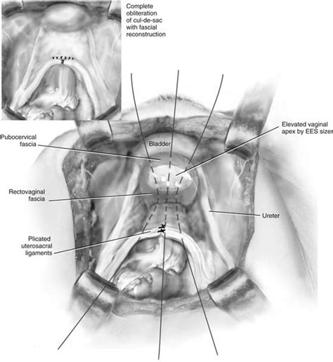 Uterosacral Ligament Anatomy