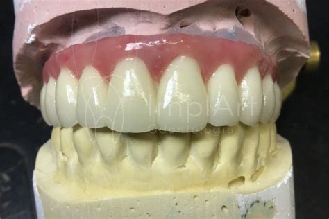 Protese Zirconia Gengiva Artificial Kb Cl Nica Odontol Gica De