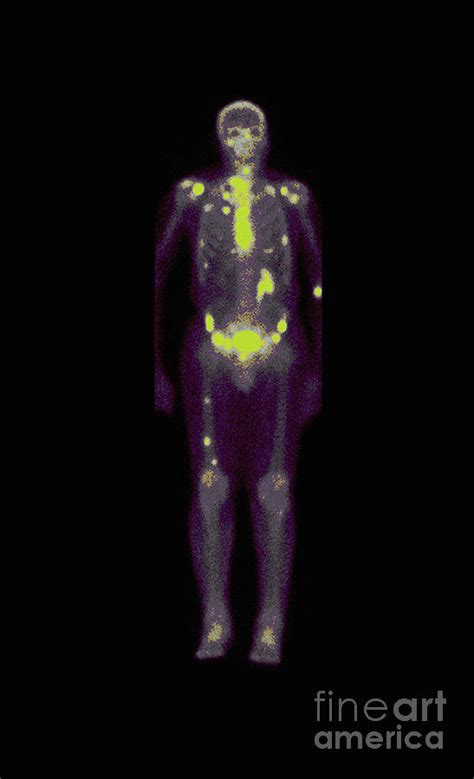 Nuclear Medicine Bone Scan Photograph by Medical Body Scans