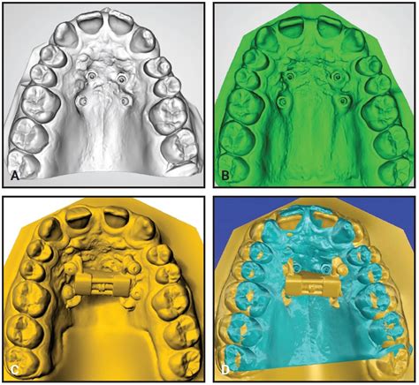 Tandem Skeletal Expander And Mapa Protocol For Palatal Expansion In